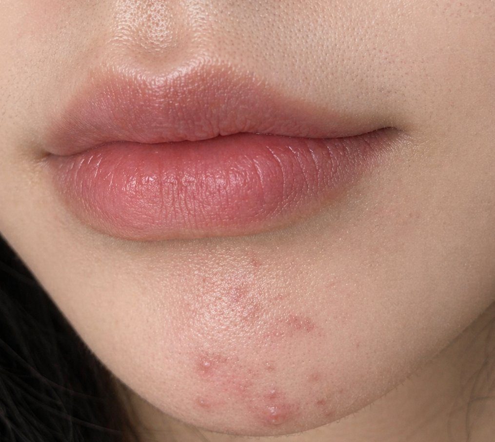 Close-up of a young East Asian woman's lips and chin, showing a slight smile and some acne.