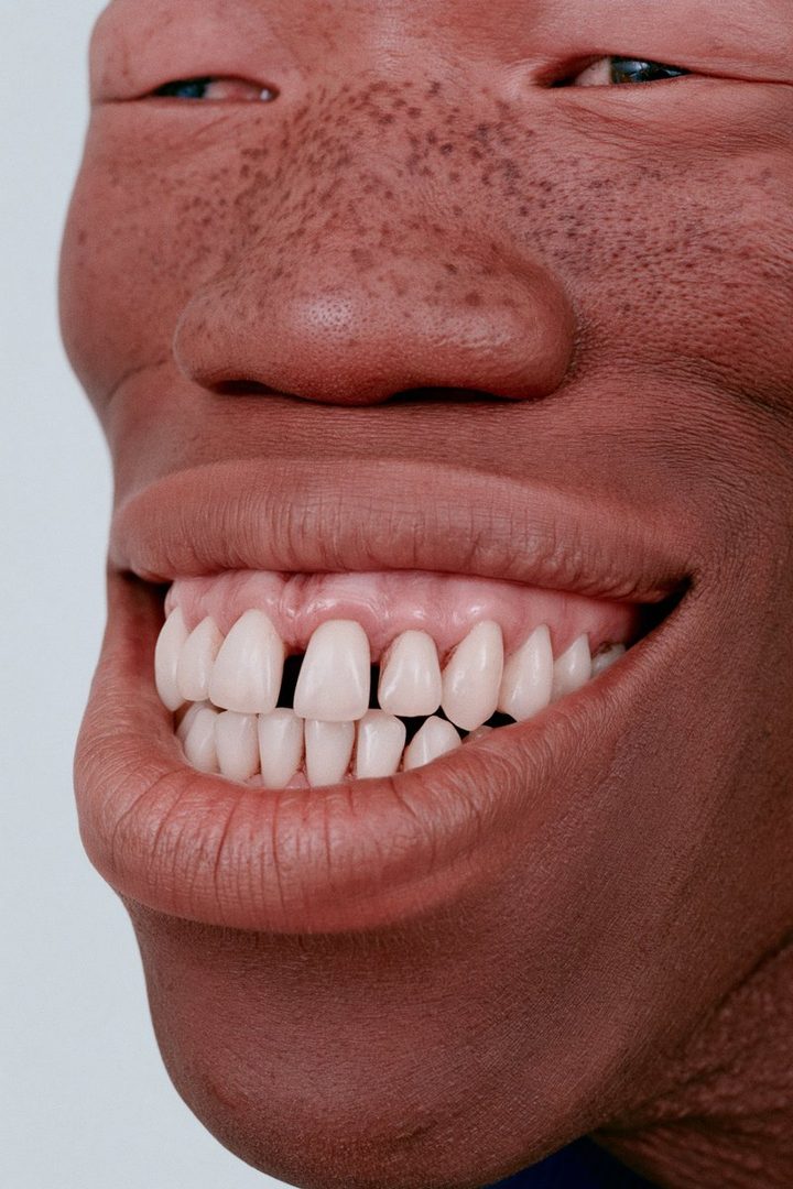 Close-up portrait of a person with dark skin, freckles, and a wide smile showing perfect white teeth.